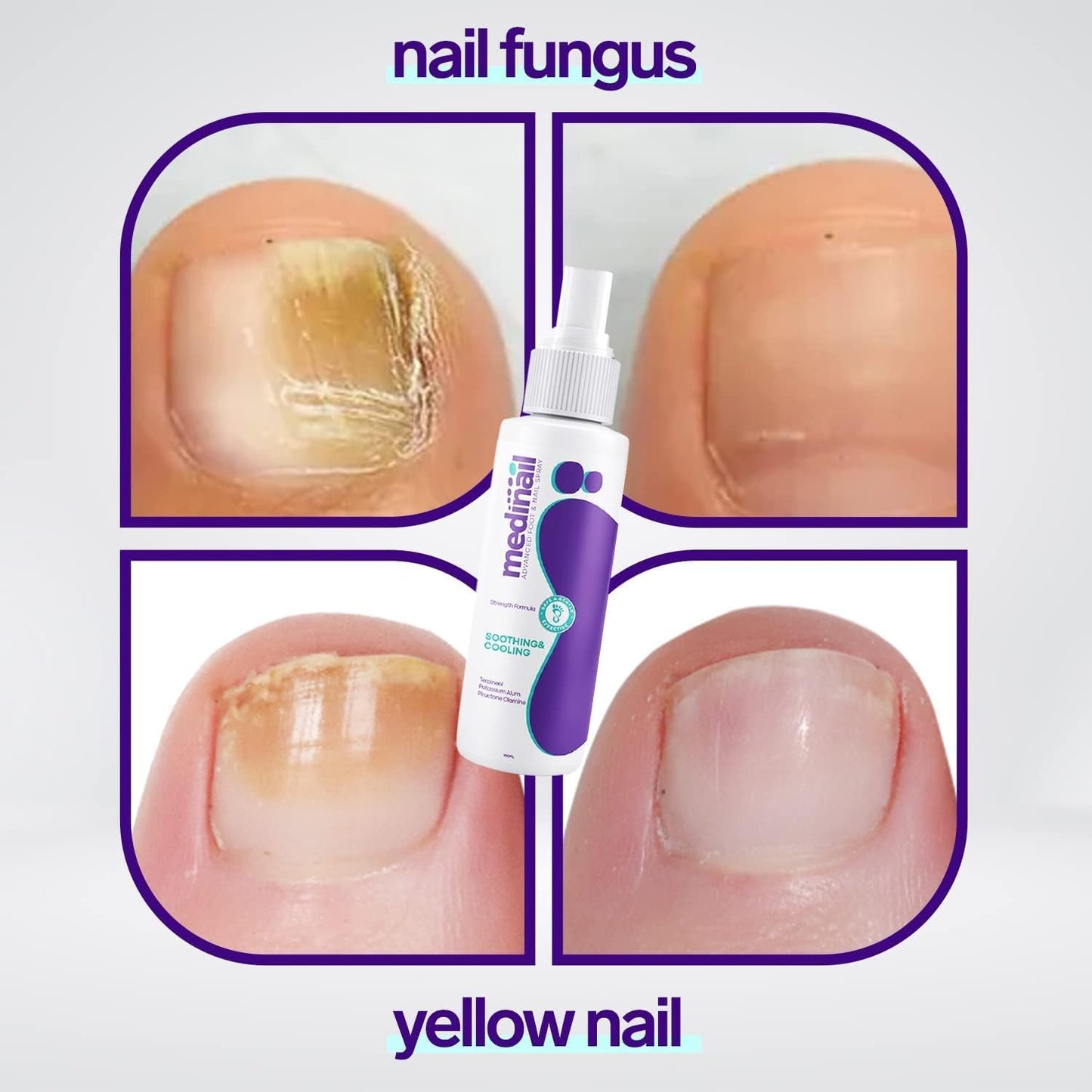 💅 Nail Fungus Spray – Protect, Heal & Restore Healthy Nails