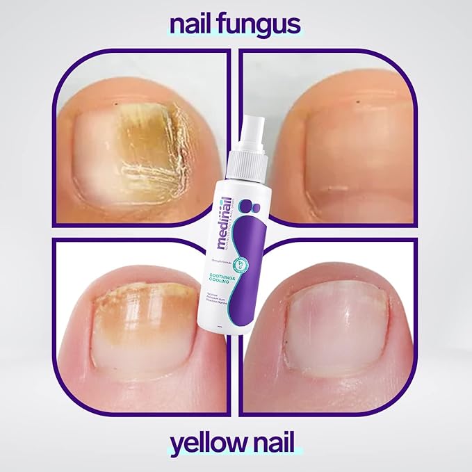 💅 Nail Fungus Spray – Protect, Heal & Restore Healthy Nails