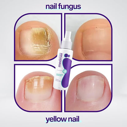 💅 Nail Fungus Spray – Protect, Heal & Restore Healthy Nails